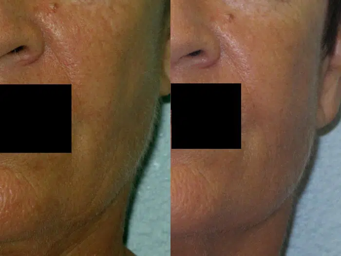 Palomar 1540 before and after photo by Medispa Maui and Wellness Center in Kihei, HI