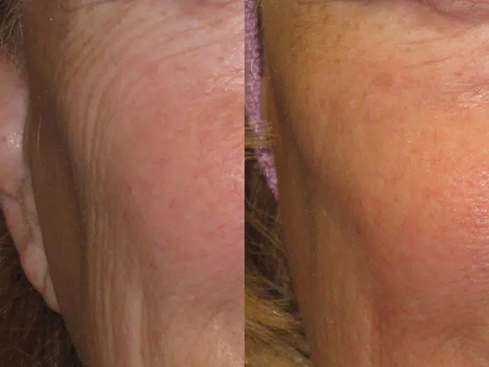 Palomar 1540 before and after photo by Medispa Maui and Wellness Center in Kihei, HI