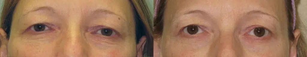 Palomar 1540 before and after photo by Medispa Maui and Wellness Center in Kihei, HI