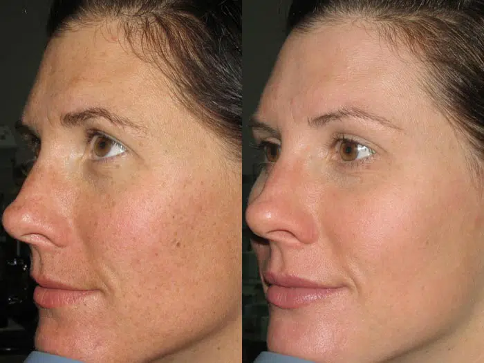 Photorejuvenation before and after photo by Medispa Maui and Wellness Center in Kihei, HI
