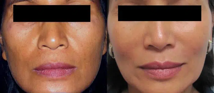 Dermal Fillers before and after photo by Medispa Maui and Wellness Center in Kihei, HI
