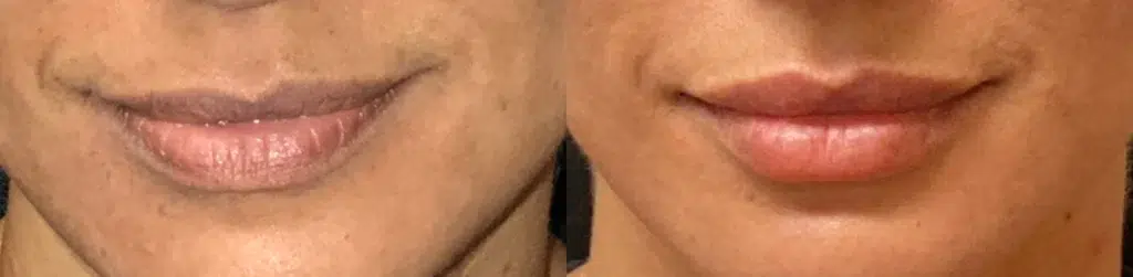 Dermal Fillers before and after photo by Medispa Maui and Wellness Center in Kihei, HI