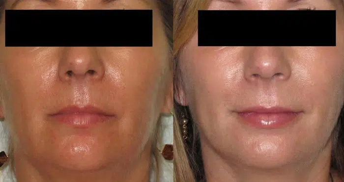 Fillers before and after photo by Medispa Maui and Wellness Center in Kihei, HI