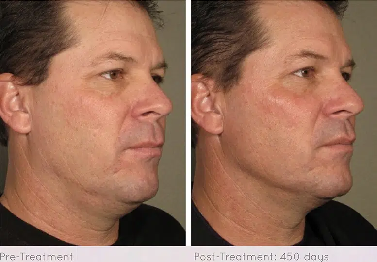 Ultherapy before and after photo by Medispa Maui and Wellness Center in Kihei, HI