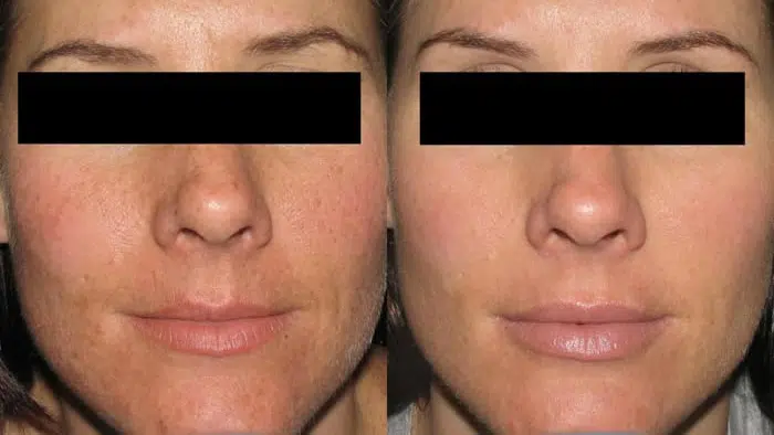 Fillers before and after photo by Medispa Maui and Wellness Center in Kihei, HI
