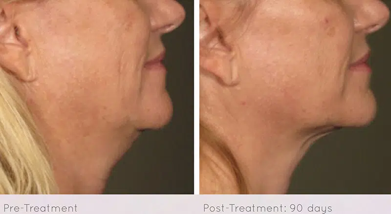Ultherapy before and after photo by Medispa Maui and Wellness Center in Kihei, HI