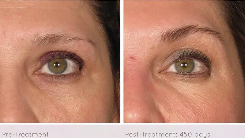 Ultherapy before and after photo by Medispa Maui and Wellness Center in Kihei, HI