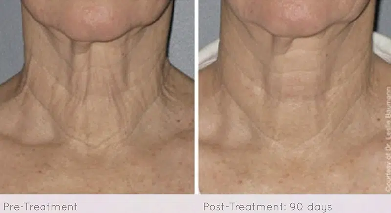 Ultherapy before and after photo by Medispa Maui and Wellness Center in Kihei, HI
