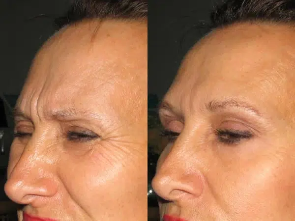 Botox before and after photo by Medispa Maui and Wellness Center in Kihei, HI