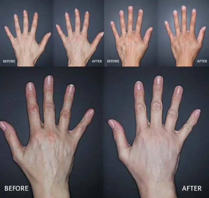 Hands rejuvenation special before and after photos