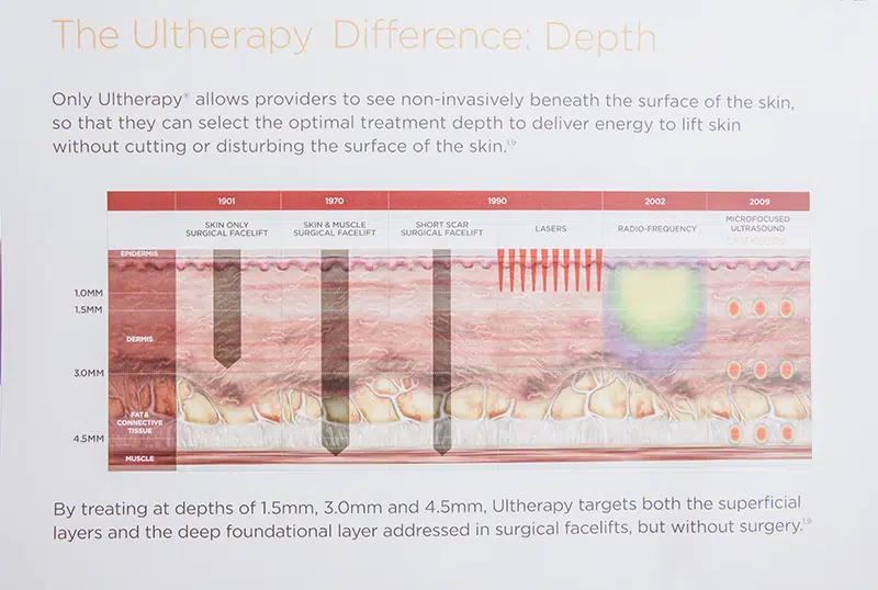 Infographics of Ultherapy difference