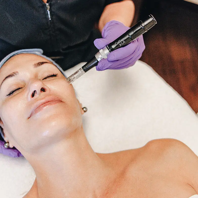 Microneedling services