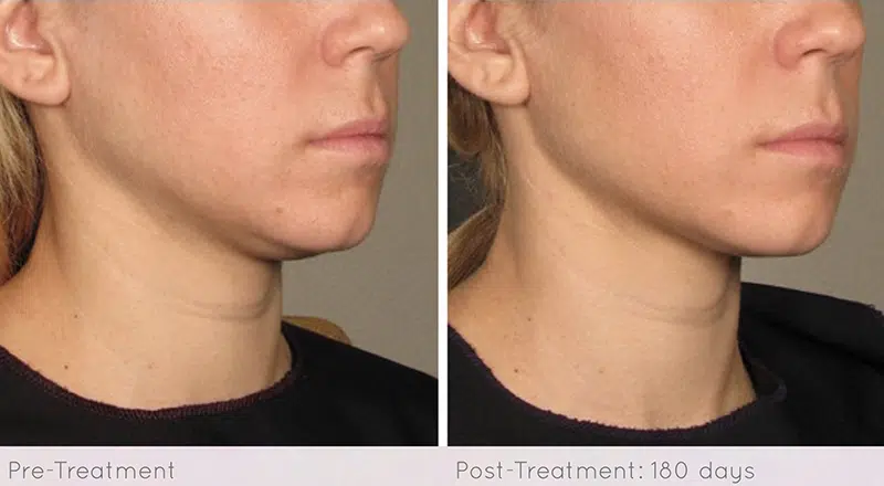 Ultherapy before and after photo by Medispa Maui and Wellness Center in Kihei, HI