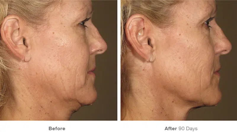 Ultherapy before and after photo by Medispa Maui and Wellness Center in Kihei, HI